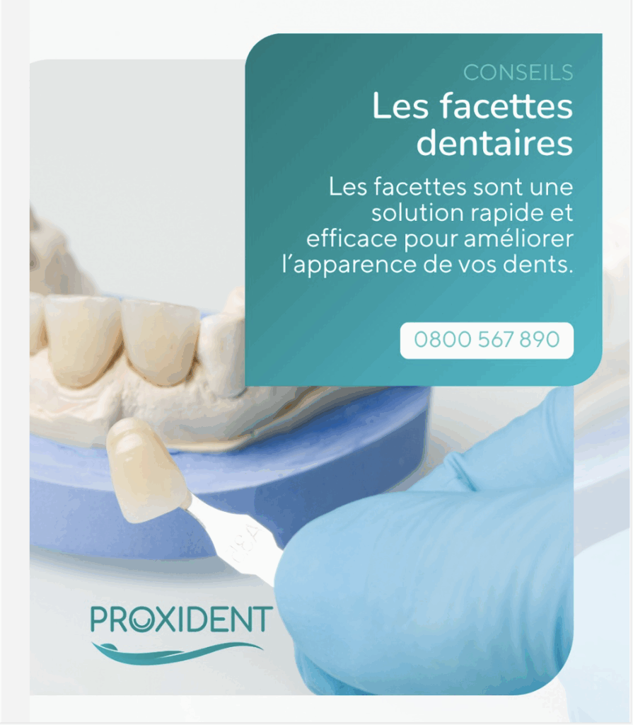 Facettes dentaires